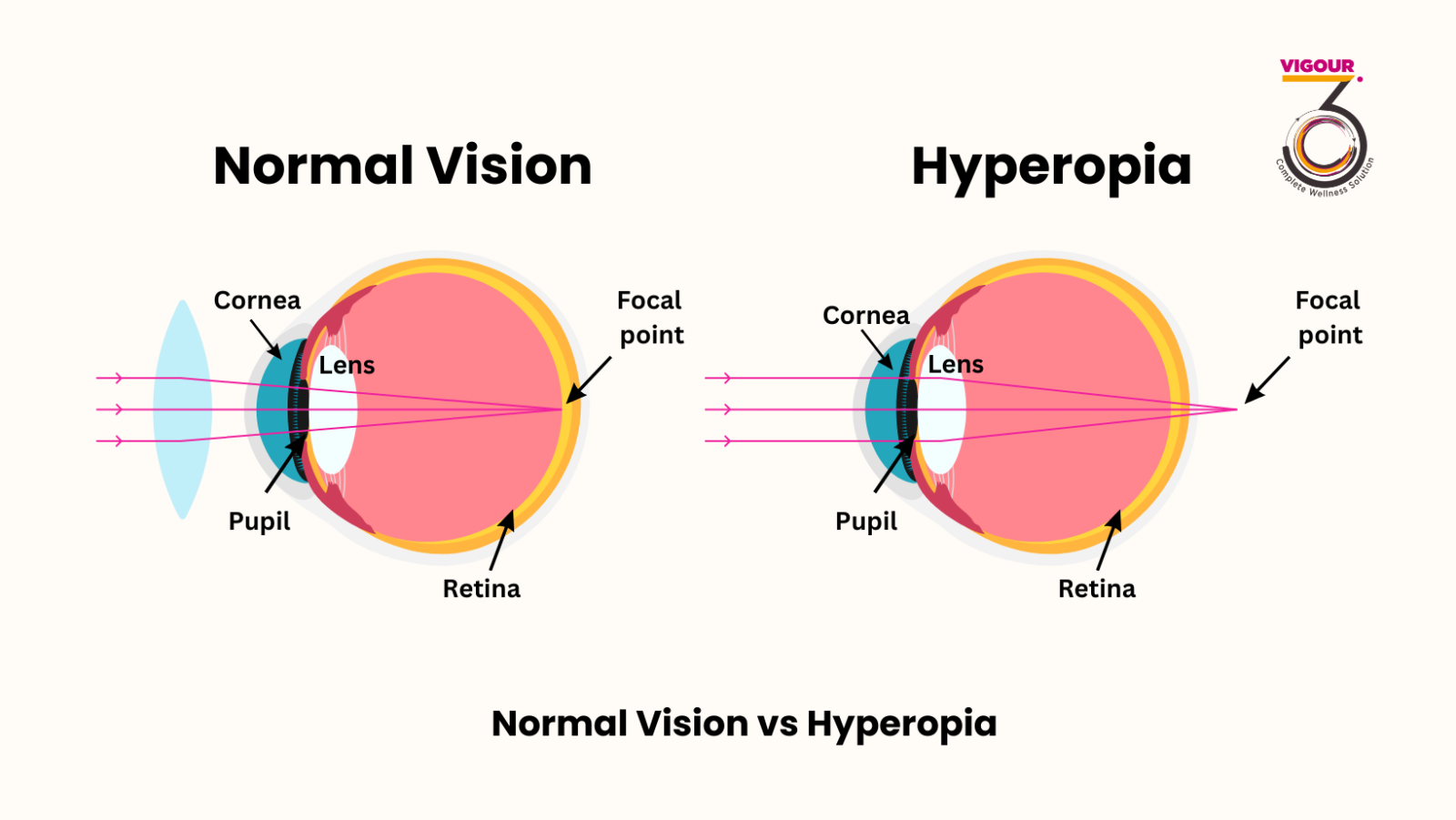 Hyperopia in children